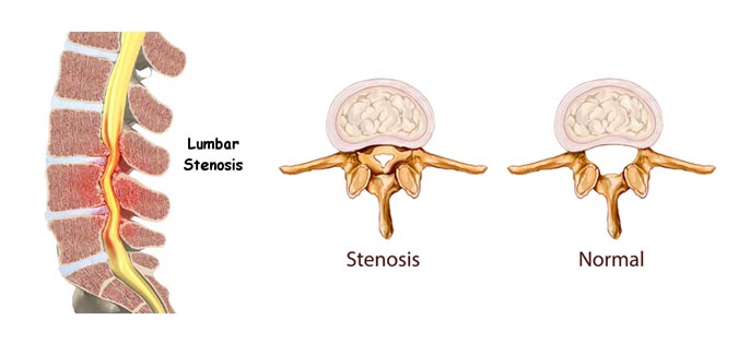 lumbar-canal-stenosis lumbar-canal-stenosis